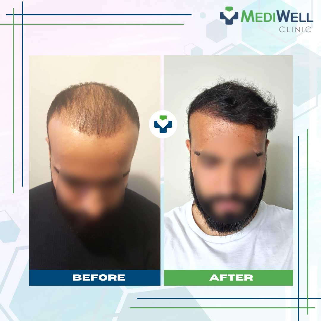 Our Hair Transplant Success Stories - MediWell Clinic