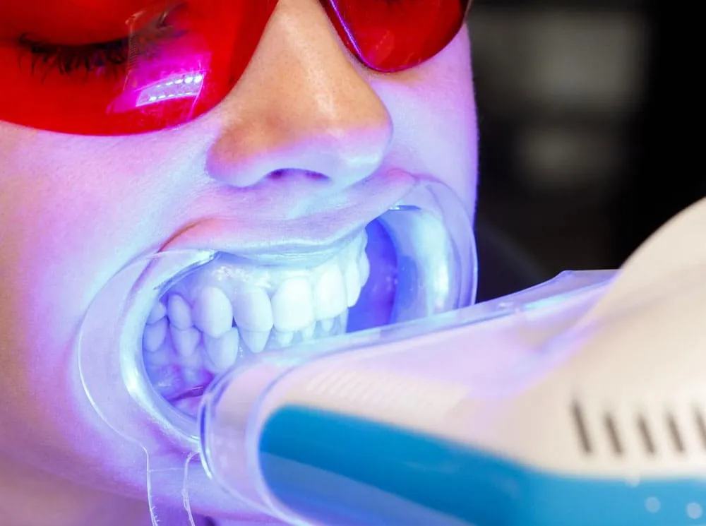 Teeth-Whitening