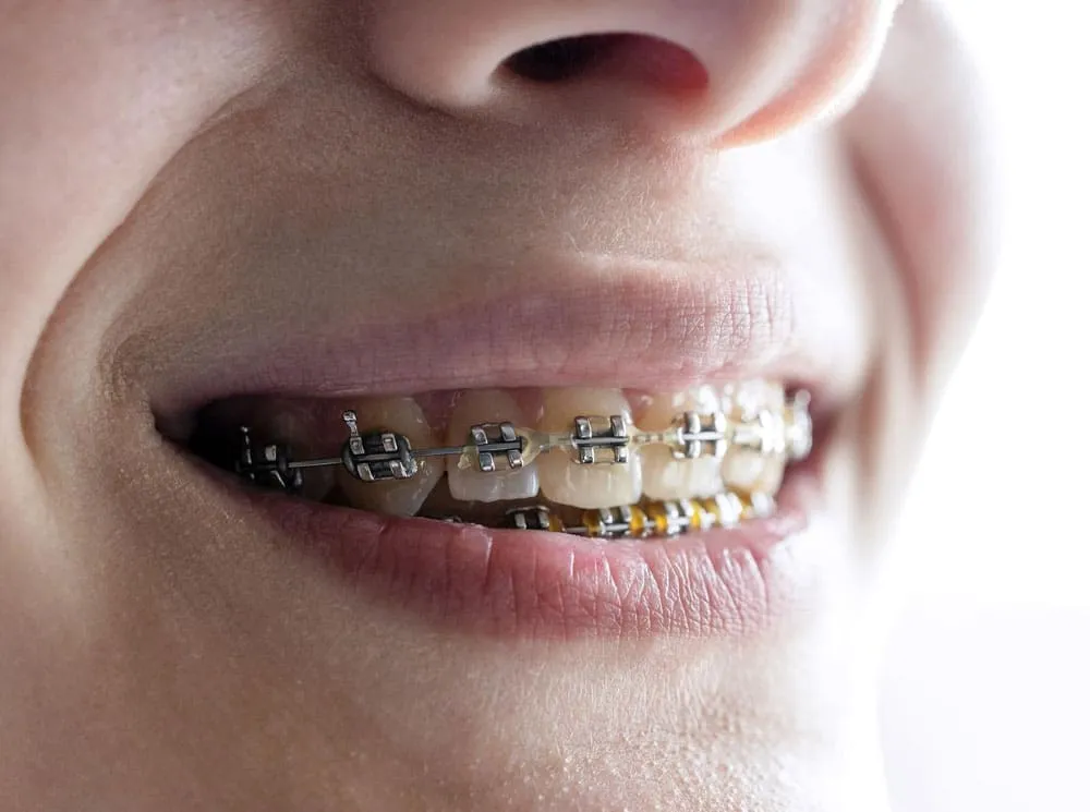 dental-brackets