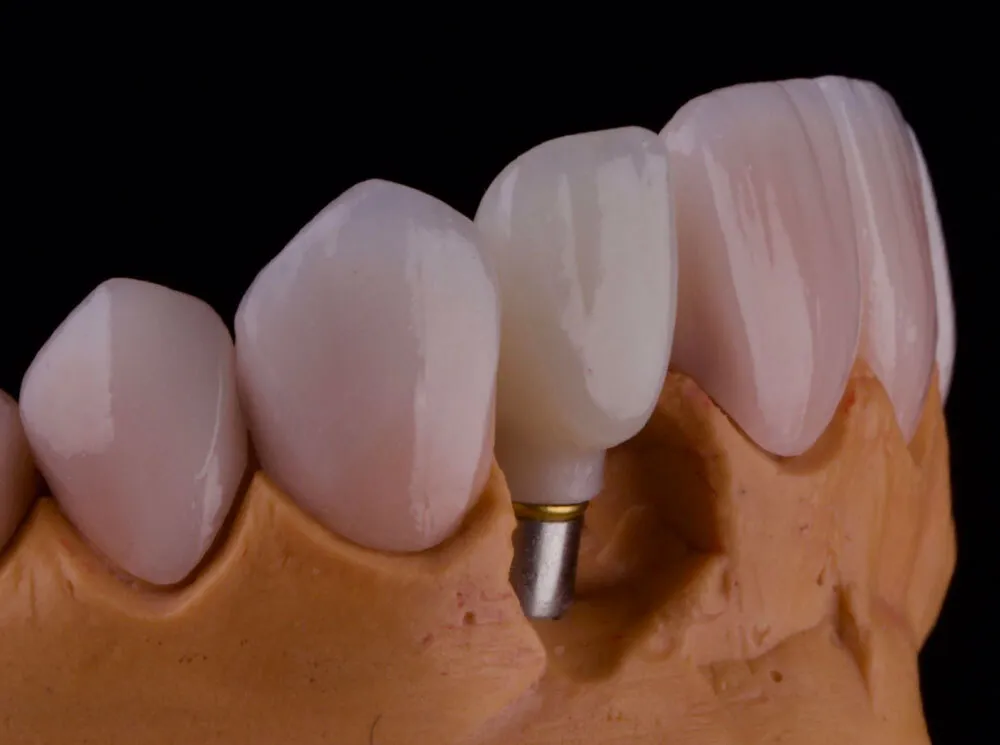 dental-implant