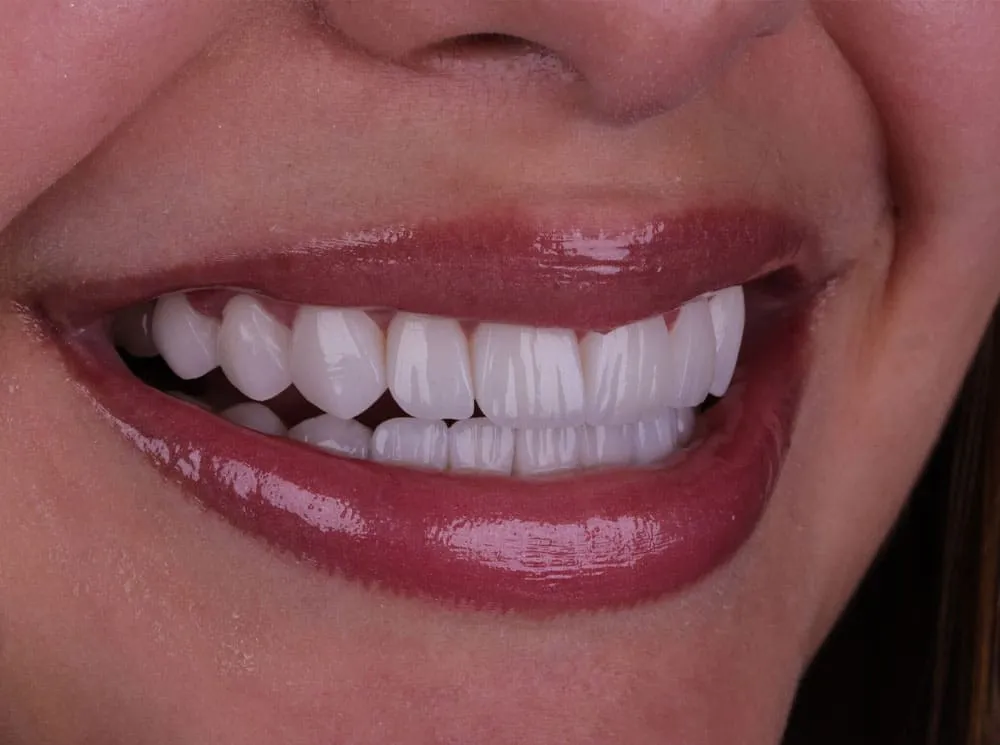 dental-veneers