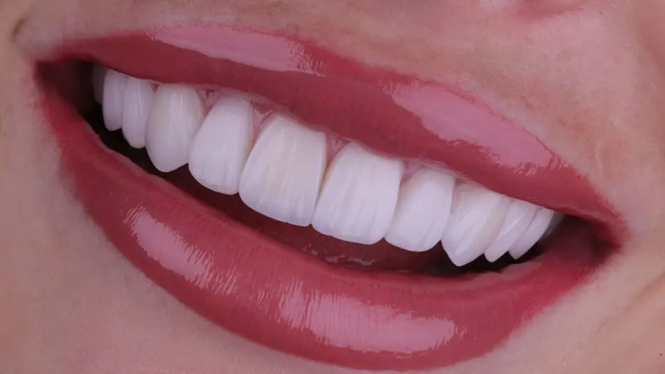 porcelain-veneers-dental-clinic