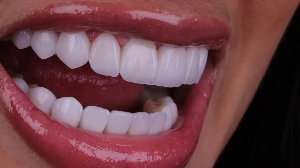 porcelain-veneers-in-london