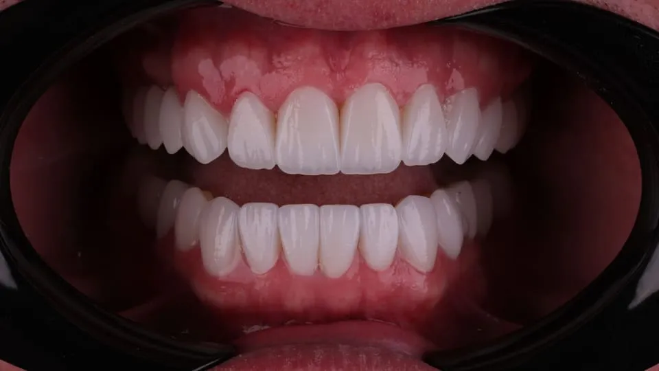 zirconium-veneers-in-london